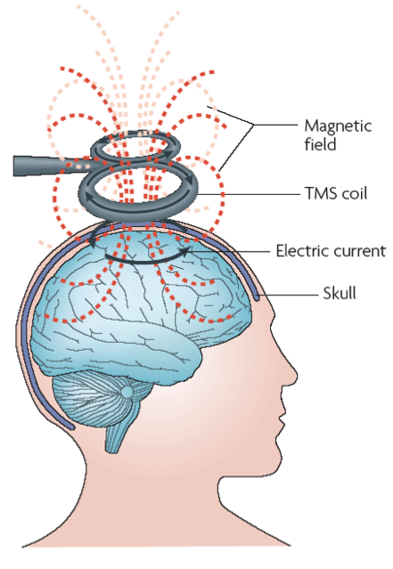 rTMS_Figure1.png