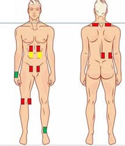 tens pad placement.jpg